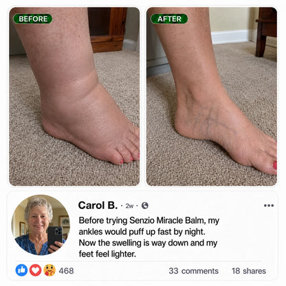 Senzio Miracle Balm™ - Soulagez l'Edème Rapidement